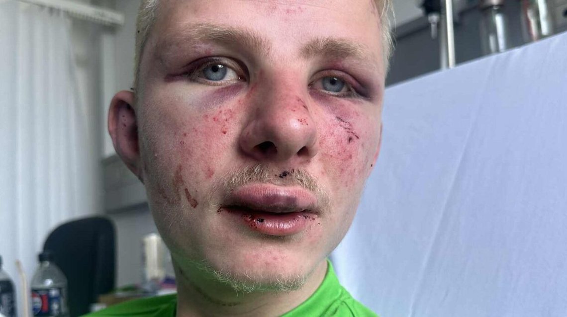 Her ses Frederik Andersen efter overfaldet i København. Her ses Frederik Andersen efter overfaldet i København.