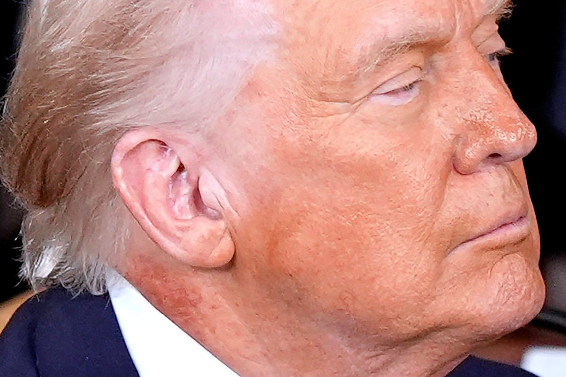 Redness is seen on the neck of President Donald Trump as he delivers the State of the Union address to a joint session of Congress in the House chamber at the U.S. Capitol in Washington, Tuesday, Feb. 24, 2026. (AP Photo/Mark Schiefelbein) Redness is seen on the neck of President Donald Trump as he delivers the State of the Union address to a joint session of Congress in the House chamber at the U.S. Capitol in Washington, Tuesday, Feb. 24, 2026. (AP Photo/Mark Schiefelbein)