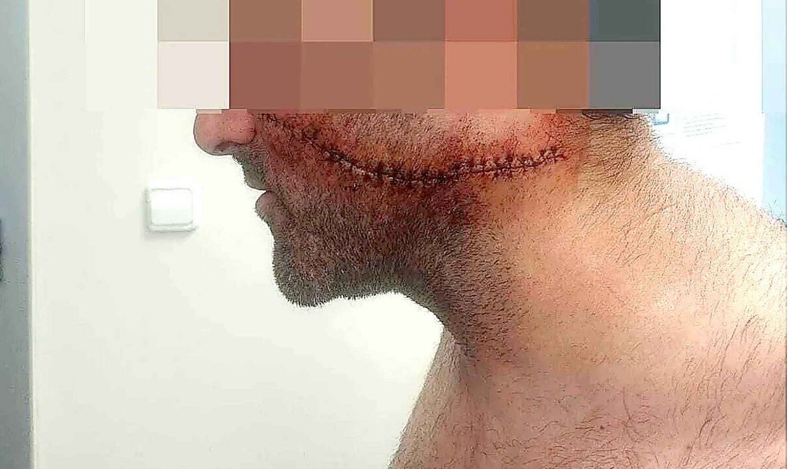 The Spanish man was badly injured to the face and neck and has developed psychological problems after the knife attack on the street in Spain. Photo: Private The Spanish man was badly injured to the face and neck and has developed psychological problems after the knife attack on the street in Spain. Photo: Private