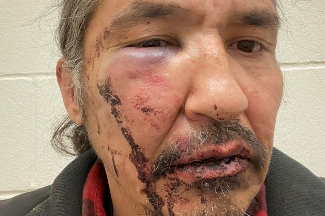 Chief Allan Adam of Athabasca Chipeywan First Nation displays his wounds that he says were caused by Royal Canadian Mounted Police (RCMP) officers of the Wood Buffalo detachment in an incident in Fort McMurray, Alberta, Canada March 10, 2020. Picture taken March 10, 2020. Courtesy of Allan Adam via REUTERS. NO RESALES. NO ARCHIVES. THIS IMAGE HAS BEEN SUPPLIED BY A THIRD PARTY. THIS IMAGE WAS PROCESSED BY REUTERS TO ENHANCE QUALITY, AN UNPROCESSED VERSION HAS BEEN PROVIDED SEPARATELY. Chief Allan Adam of Athabasca Chipeywan First Nation displays his wounds that he says were caused by Royal Canadian Mounted Police (RCMP) officers of the Wood Buffalo detachment in an incident in Fort McMurray, Alberta, Canada March 10, 2020. Picture taken March 10, 2020. Courtesy of Allan Adam via REUTERS. NO RESALES. NO ARCHIVES. THIS IMAGE HAS BEEN SUPPLIED BY A THIRD PARTY. THIS IMAGE WAS PROCESSED BY REUTERS TO ENHANCE QUALITY, AN UNPROCESSED VERSION HAS BEEN PROVIDED SEPARATELY.