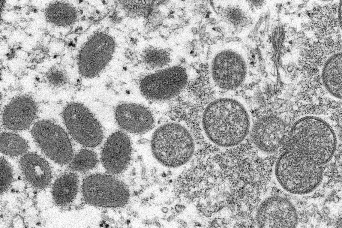 This 2003 electron microscope image made available by the Centers for Disease Control and Prevention shows mature, oval-shaped monkeypox virions, left, and spherical immature virions, right, obtained from a sample of human skin associated with the 2003 prairie dog outbreak. On Wednesday, May 18, 2022, Portuguese health authorities confirmed five cases of monkeypox in young men, marking an unusual outbreak in Europe of a disease typically limited to Africa. (Cynthia S. Goldsmith, Russell Regner/CDC via AP) This 2003 electron microscope image made available by the Centers for Disease Control and Prevention shows mature, oval-shaped monkeypox virions, left, and spherical immature virions, right, obtained from a sample of human skin associated with the 2003 prairie dog outbreak. On Wednesday, May 18, 2022, Portuguese health authorities confirmed five cases of monkeypox in young men, marking an unusual outbreak in Europe of a disease typically limited to Africa. (Cynthia S. Goldsmith, Russell Regner/CDC via AP)