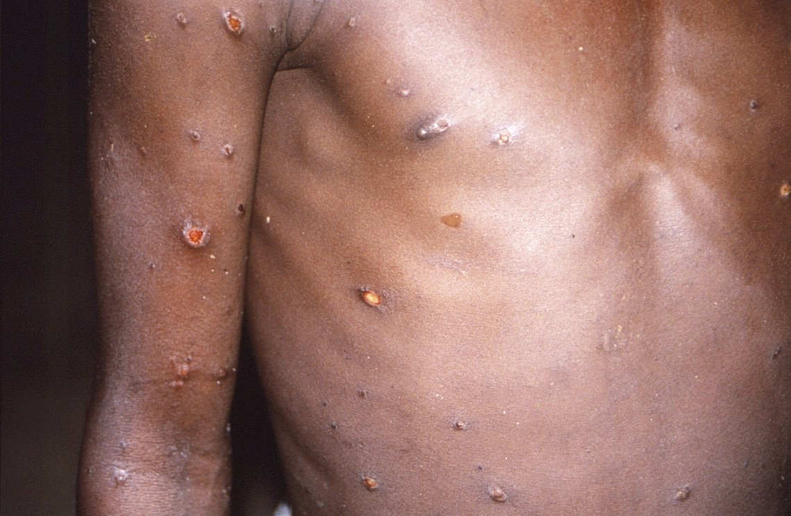 Dette bildet fra 1997 levert av CDC, viser høyre arm og overkropp for en pasient, hvis hud viste en rekke lesjoner på grunn av det som var et aktivt utbrudd av apekopper. Ettersom flere tilfeller av Monkeypox oppdages i Europa og Nord -Amerika i 2022, sier noen forskere som har overvåket mange utbrudd i Afrika, at de er forvirret over den uvanlige sykdommens spredning i utviklede land. Foto: CDC via AP / NTB Dette bildet fra 1997 levert av CDC, viser høyre arm og overkropp for en pasient, hvis hud viste en rekke lesjoner på grunn av det som var et aktivt utbrudd av apekopper. Ettersom flere tilfeller av Monkeypox oppdages i Europa og Nord -Amerika i 2022, sier noen forskere som har overvåket mange utbrudd i Afrika, at de er forvirret over den uvanlige sykdommens spredning i utviklede land. Foto: CDC via AP / NTB