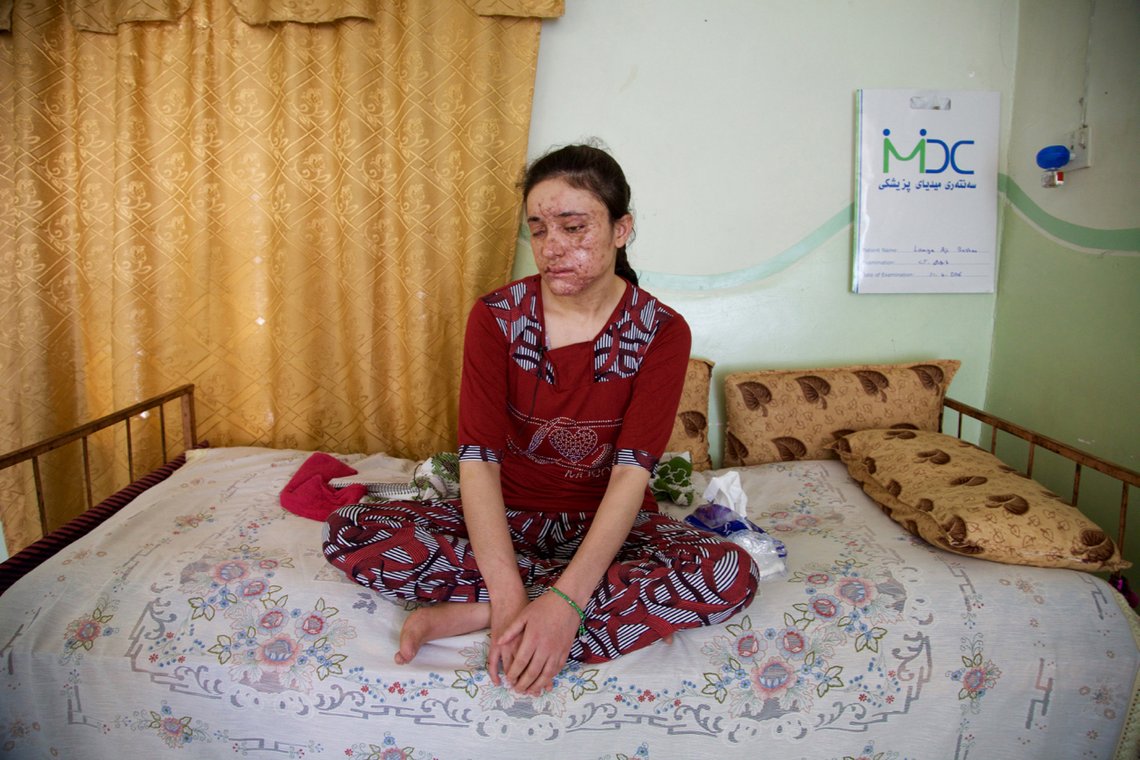 Lamiya Aji Bashar, 18 år gammel jesidi, rømte fra Islamsk Stat. Femte fluktforsøk lykkes. Hennes to medsøstre ble drept av en mine. Bashar fikk ansiktet vansiret og et øye blindet. Foto: Balint Szlanko / AP / NTB Lamiya Aji Bashar, 18 år gammel jesidi, rømte fra Islamsk Stat. Femte fluktforsøk lykkes. Hennes to medsøstre ble drept av en mine. Bashar fikk ansiktet vansiret og et øye blindet. Foto: Balint Szlanko / AP / NTB