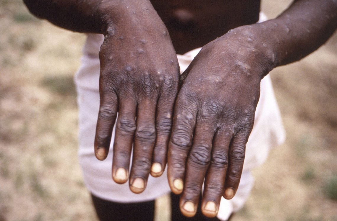 Arkivbilde fra 1997 under et utbrudd av apekopper i Den Demokratiske republikken Kongo. Pasienten som er avbildet er i ferd med å bli frisk av sykdommen. (CDC via AP, File) Arkivbilde fra 1997 under et utbrudd av apekopper i Den Demokratiske republikken Kongo. Pasienten som er avbildet er i ferd med å bli frisk av sykdommen. (CDC via AP, File)