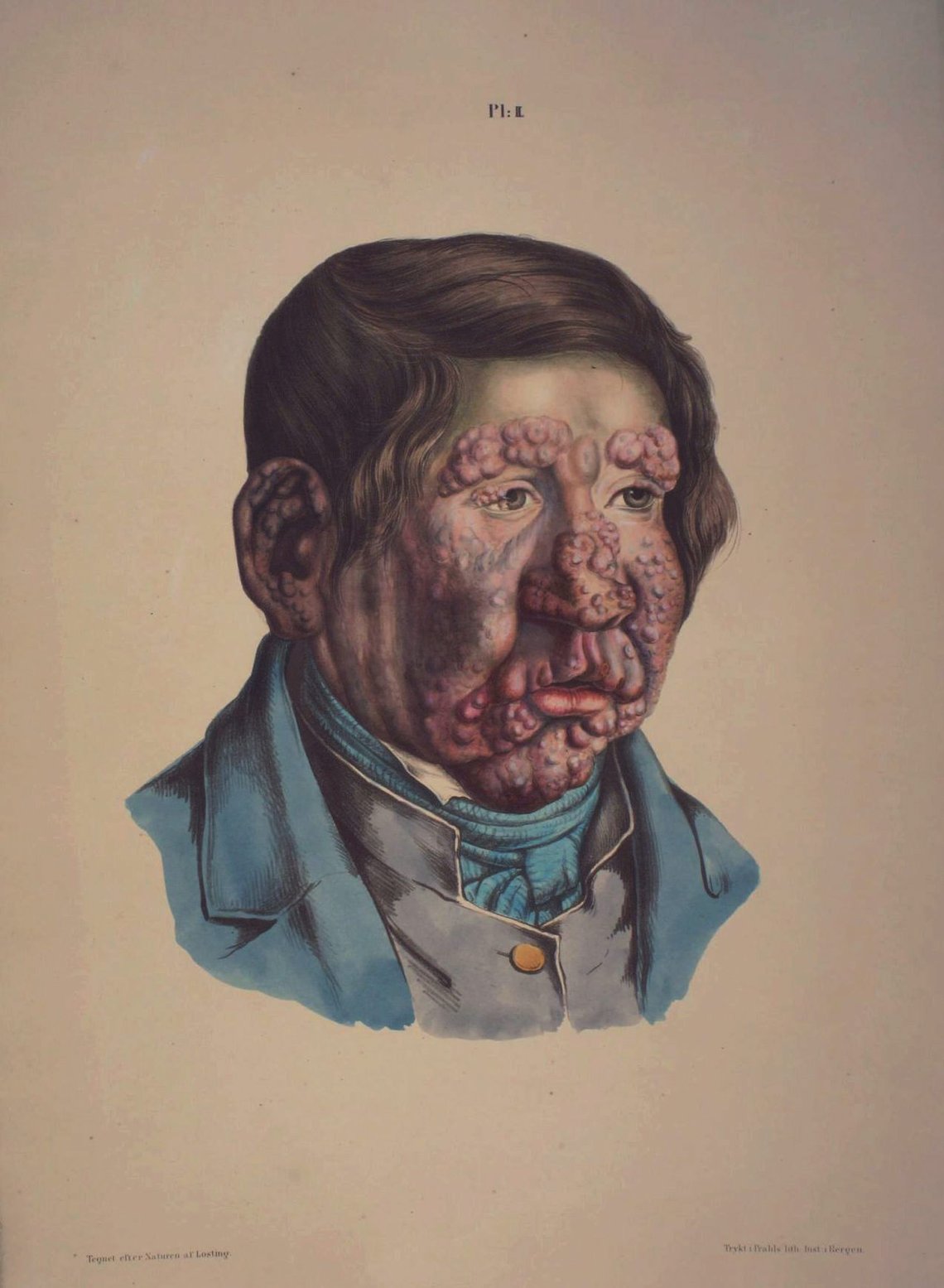 Bergen 20030610
Gammel illustrasjon fra 1840-årene tegnet av J. L. Losting av en leprapasient ved St.Jørgens Hospital i Bergen. Lørdag åpner utstillingen "Her er smittsom sykdom!". ved Lepramuseet.
Foto: Lepramuseet St.Jørgens Hospital / Scanpix Bergen 20030610
Gammel illustrasjon fra 1840-årene tegnet av J. L. Losting av en leprapasient ved St.Jørgens Hospital i Bergen. Lørdag åpner utstillingen "Her er smittsom sykdom!". ved Lepramuseet.
Foto: Lepramuseet St.Jørgens Hospital / Scanpix