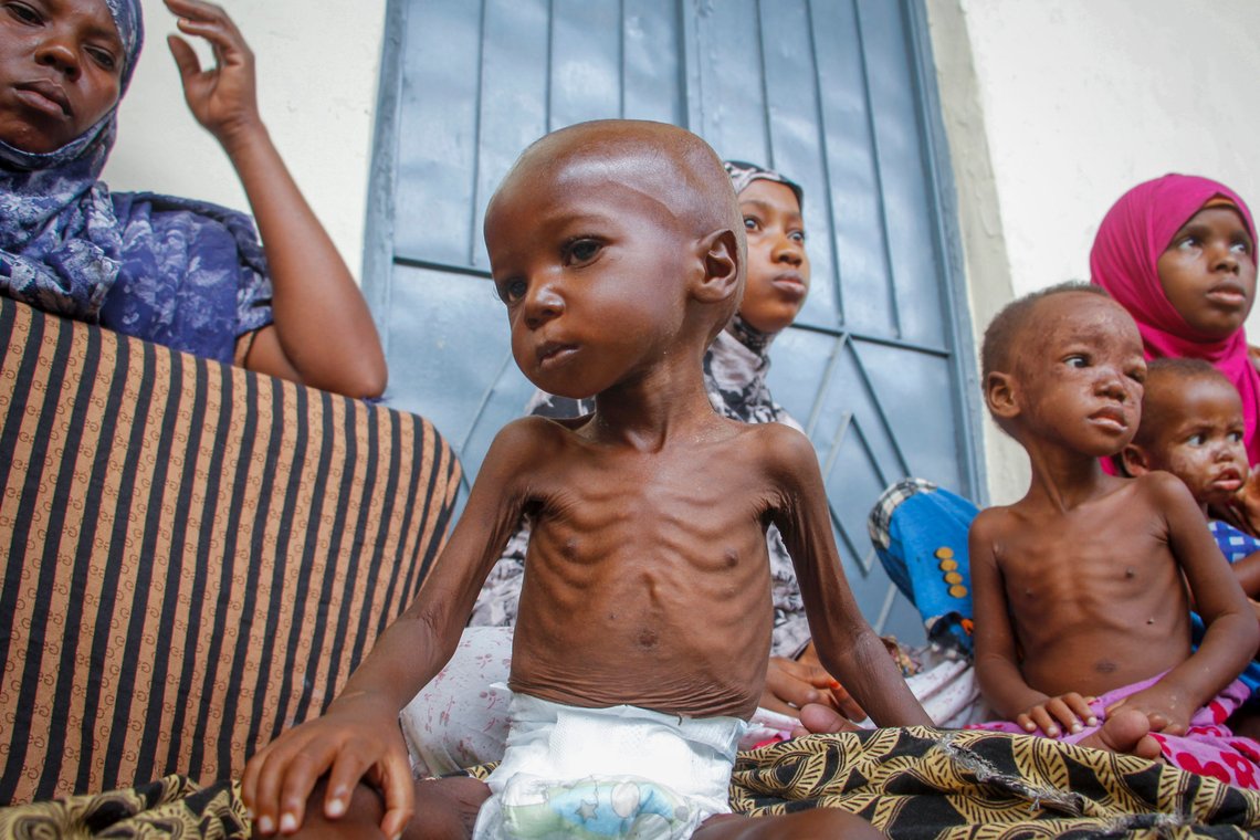 En underernært gutt på to år på et krisesenter mot sult i Mogadishu i Somalia 5. juni i fjor. Somalia er blant landene som opplever en kraftig økning i tallet på mennesker som sulter. Foto: Farah Abdi Warsameh, AP / NTB. En underernært gutt på to år på et krisesenter mot sult i Mogadishu i Somalia 5. juni i fjor. Somalia er blant landene som opplever en kraftig økning i tallet på mennesker som sulter. Foto: Farah Abdi Warsameh, AP / NTB.