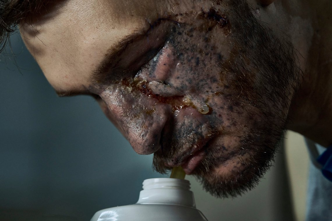 Soldier Andriy drinks water in a hospital in Kyiv, Ukraine, Monday, July 10, 2023. Andriy is a Ukrainian army 47th brigade air reconnaissance officer, code name Apostle, who was heavily wounded in a battle with Russian troops in the Zaporizhzhia region. (AP Photo/Libkos) Soldier Andriy drinks water in a hospital in Kyiv, Ukraine, Monday, July 10, 2023. Andriy is a Ukrainian army 47th brigade air reconnaissance officer, code name Apostle, who was heavily wounded in a battle with Russian troops in the Zaporizhzhia region. (AP Photo/Libkos)