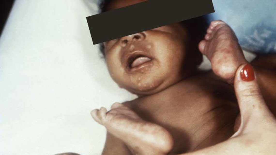 Utslett på haken og leppene samt mørkpigmenterte flekker på fotsålene er mulige symptomer på medfødt syfilisinfeksjon. Foto: CDC/Susan Lindsley, Wikimedia Commons Utslett på haken og leppene samt mørkpigmenterte flekker på fotsålene er mulige symptomer på medfødt syfilisinfeksjon. Foto: CDC/Susan Lindsley, Wikimedia Commons