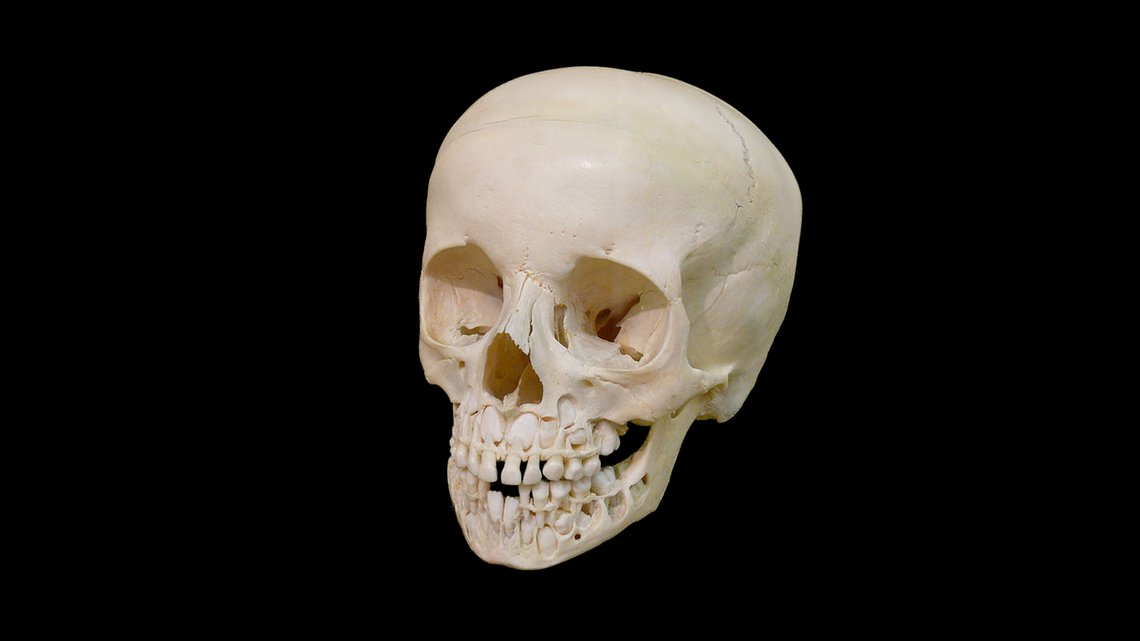 Hodeskalle av barn, Basel anatomiske museum. Illustrasjonsfoto: Amada44, Wikimedia Commons CC BY-SA 3.0 DEED Hodeskalle av barn, Basel anatomiske museum. Illustrasjonsfoto: Amada44, Wikimedia Commons CC BY-SA 3.0 DEED