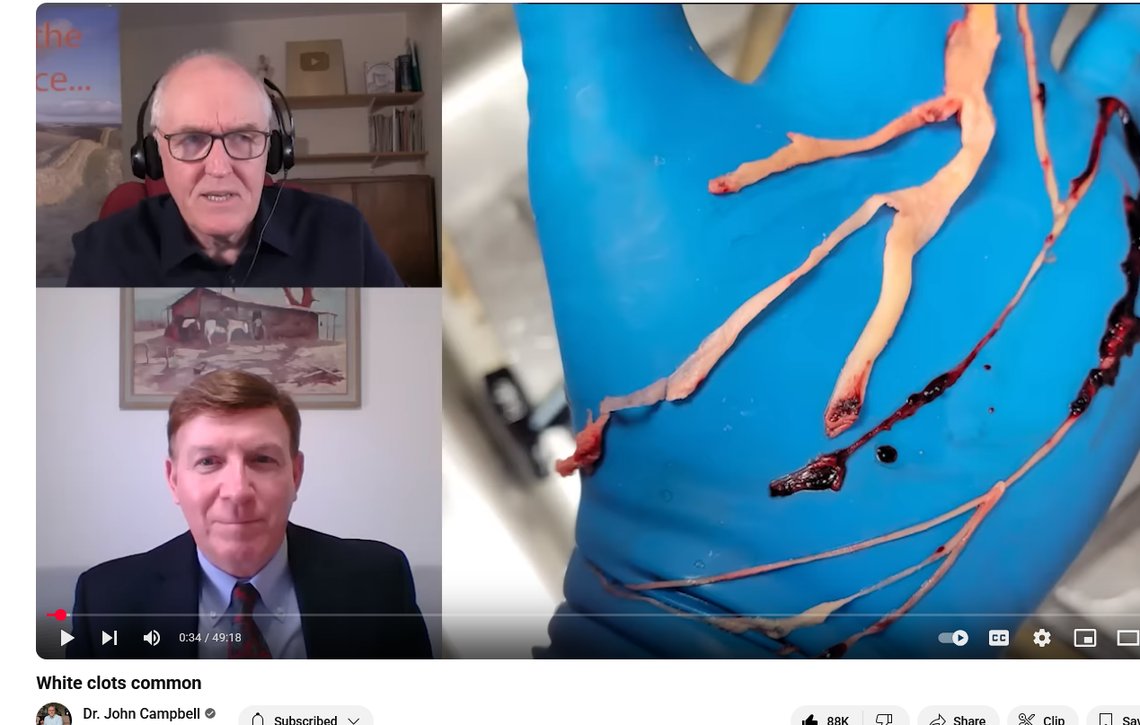 John Campbell (øverst, med briller) diskuterer de nye hvite blodproppene med Tom Haviland, som har gjennomført spørreundersøkelser over hvor mange balsamerere som har sett disse hvite blodproppene. Skjermdump fra YouTube. John Campbell (øverst, med briller) diskuterer de nye hvite blodproppene med Tom Haviland, som har gjennomført spørreundersøkelser over hvor mange balsamerere som har sett disse hvite blodproppene. Skjermdump fra YouTube.