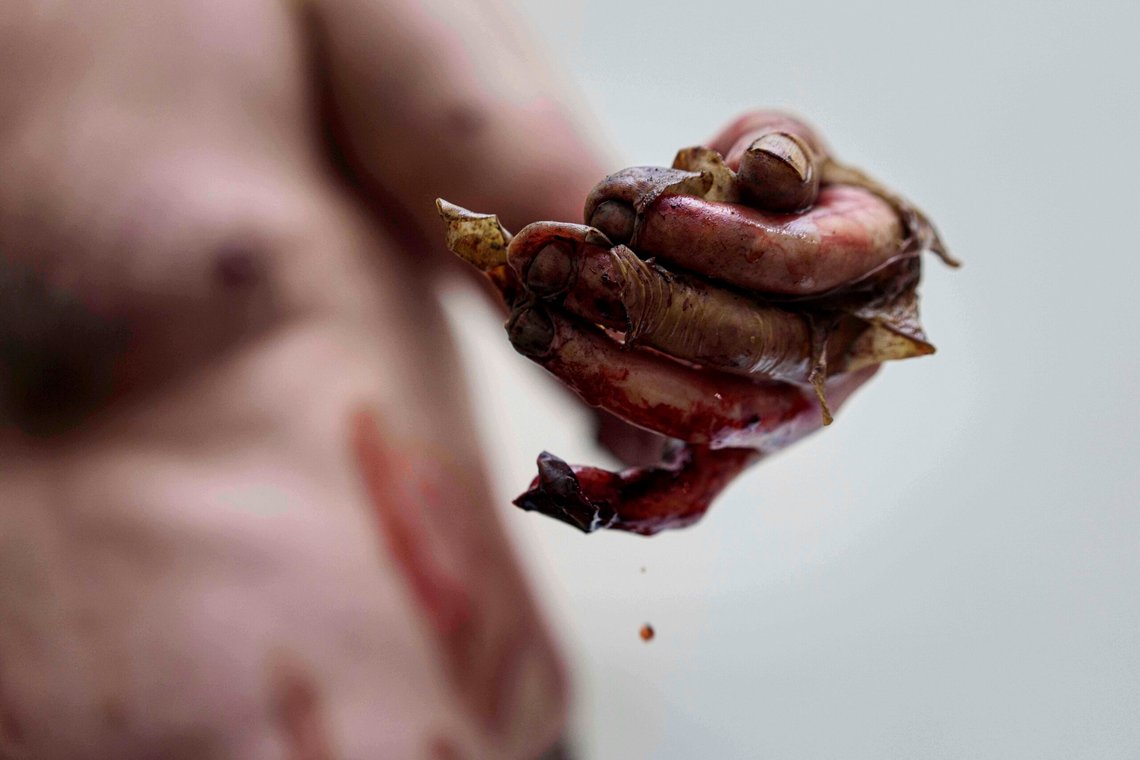 EDS NOTE: GRAPHIC CONTENT - Burns on a hand of a Ukrainian soldier who was injured during fighting with Russian forces on the front line, at stabilization point of Da Vinci Wolves Battalion on Pokrovsk direction, Ukraine, on Monday, Aug. 11, 2025. (AP Photo/Evgeniy Maloletka) EDS NOTE: GRAPHIC CONTENT - Burns on a hand of a Ukrainian soldier who was injured during fighting with Russian forces on the front line, at stabilization point of Da Vinci Wolves Battalion on Pokrovsk direction, Ukraine, on Monday, Aug. 11, 2025. (AP Photo/Evgeniy Maloletka)
