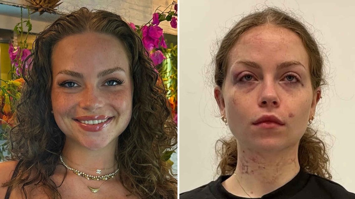 Emma Røsand (25) ble utsatt for en brutal voldtekt hvor hun ble forsøkt kvalt til døde. Nå lever hun med permanente skader, mens gjerningsmannen slipper ut etter to år og åtte måneder. Foto: Privat Emma Røsand (25) ble utsatt for en brutal voldtekt hvor hun ble forsøkt kvalt til døde. Nå lever hun med permanente skader, mens gjerningsmannen slipper ut etter to år og åtte måneder. Foto: Privat