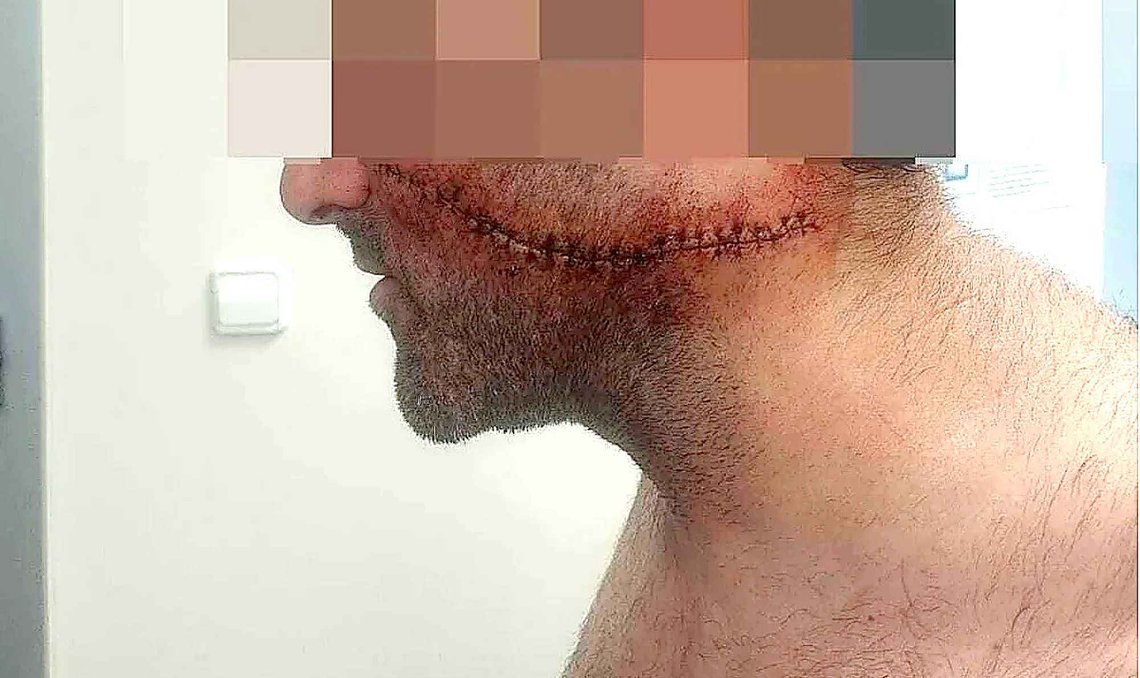 Den spanske mannen ble stygt skadet i ansiktet og på halsen og har fått psykiske problemer etter knivangrepet på gaten i Spania. (Foto: Privat) Den spanske mannen ble stygt skadet i ansiktet og på halsen og har fått psykiske problemer etter knivangrepet på gaten i Spania. (Foto: Privat)
