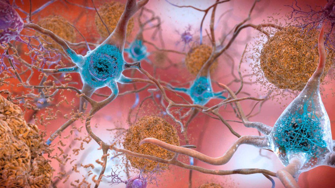 This illustration made available by the National Institute on Aging/National Institutes of Health depicts cells in an Alzheimer’s affected brain, with abnormal levels of the beta-amyloid protein clumping together to form plaques, brown, that collect between neurons and disrupt cell function. Abnormal collections of the tau protein accumulate and form tangles, blue, within neurons, harming synaptic communication between nerve cells. An experimental Alzheimer’s drug modestly slowed the brain disease’s inevitable worsening, researchers reported Tuesday, Nov. 29, 2022 - and the next question is how much difference that might make in people’s lives. Japanese drugmaker Eisai and its U.S. partner Biogen had announced earlier this fall that the drug lecanemab appeared to work, a badly needed bright spot after repeated disappointments in the quest for better Alzheimer’s treatments. (National Institute on Aging, NIH via AP) This illustration made available by the National Institute on Aging/National Institutes of Health depicts cells in an Alzheimer’s affected brain, with abnormal levels of the beta-amyloid protein clumping together to form plaques, brown, that collect between neurons and disrupt cell function. Abnormal collections of the tau protein accumulate and form tangles, blue, within neurons, harming synaptic communication between nerve cells. An experimental Alzheimer’s drug modestly slowed the brain disease’s inevitable worsening, researchers reported Tuesday, Nov. 29, 2022 - and the next question is how much difference that might make in people’s lives. Japanese drugmaker Eisai and its U.S. partner Biogen had announced earlier this fall that the drug lecanemab appeared to work, a badly needed bright spot after repeated disappointments in the quest for better Alzheimer’s treatments. (National Institute on Aging, NIH via AP)