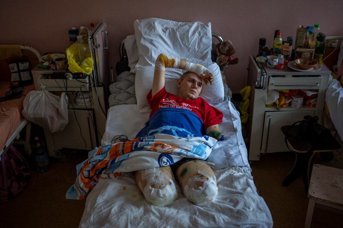 Den 22-årige ukrainske soldaten Anton Gladun ligger på sjukhus i Cherkasy den 5 maj 2022 efter att ha förlorat båda benen och en arm i en minexplosion på krigsfronten i östra Ukraina. Foto: Emilio Morenatti / AP / NTB. Den 22-årige ukrainske soldaten Anton Gladun ligger på sjukhus i Cherkasy den 5 maj 2022 efter att ha förlorat båda benen och en arm i en minexplosion på krigsfronten i östra Ukraina. Foto: Emilio Morenatti / AP / NTB.